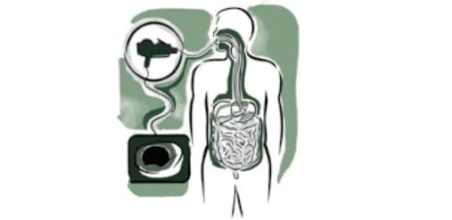 Percutaneous Endoscopic Gastrostomy(PEG)