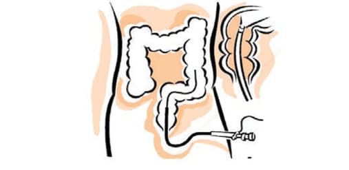 Flexible Sigmoidoscopy